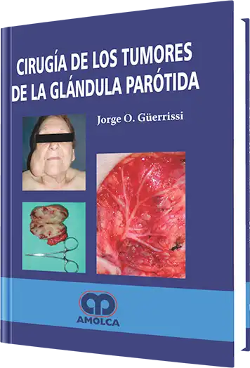 Cirugía de los Tumores de la Glándula Parótida
