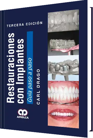 Restauraciones con Implantes. Guía Paso a Paso. 3 edición