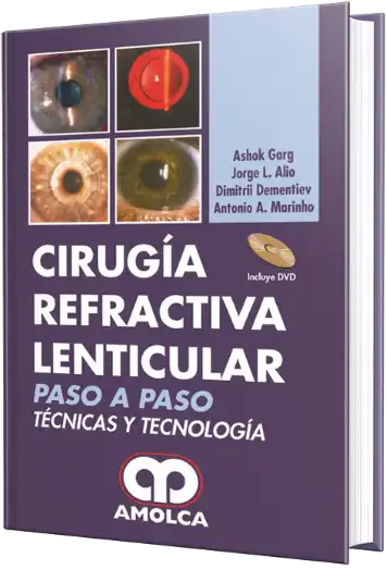 Cirugía Refractiva Lenticular Paso a Paso Técnicas y Tecnología