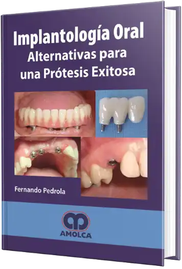 Implantología Oral Alternativas para una Prótesis Exitosa